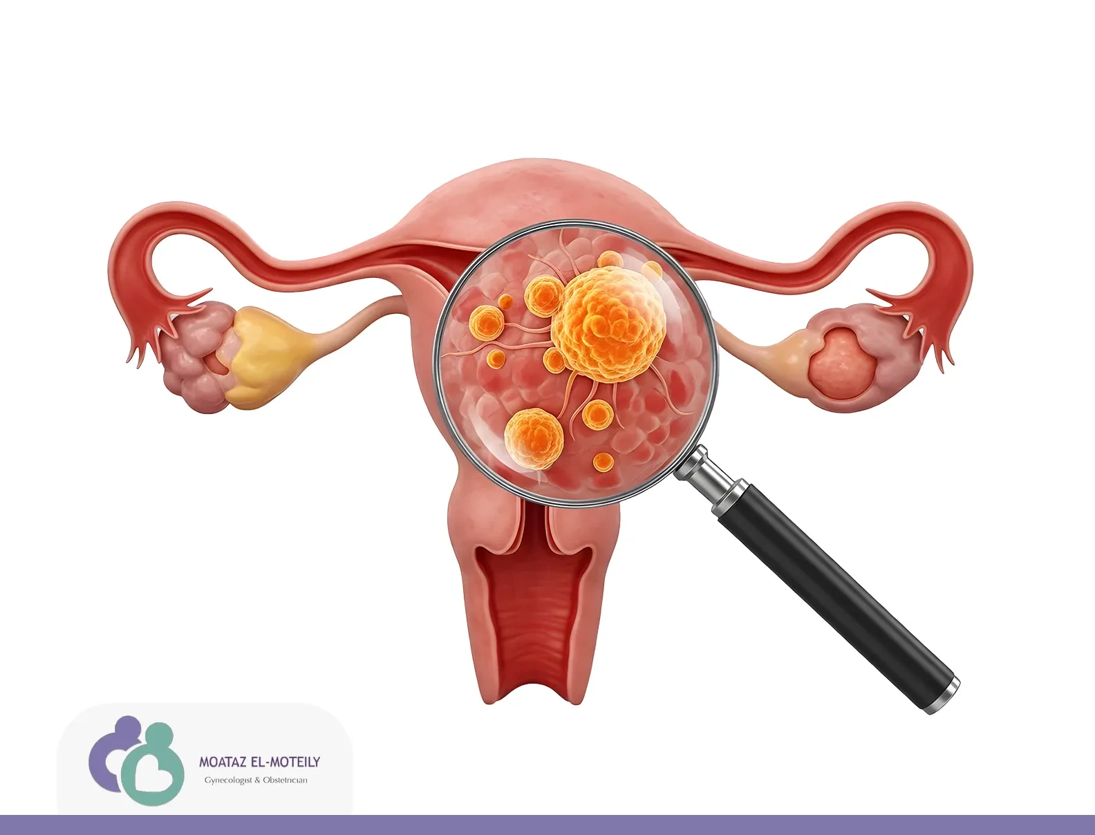 أعراض الورم الليفي في الرحم
