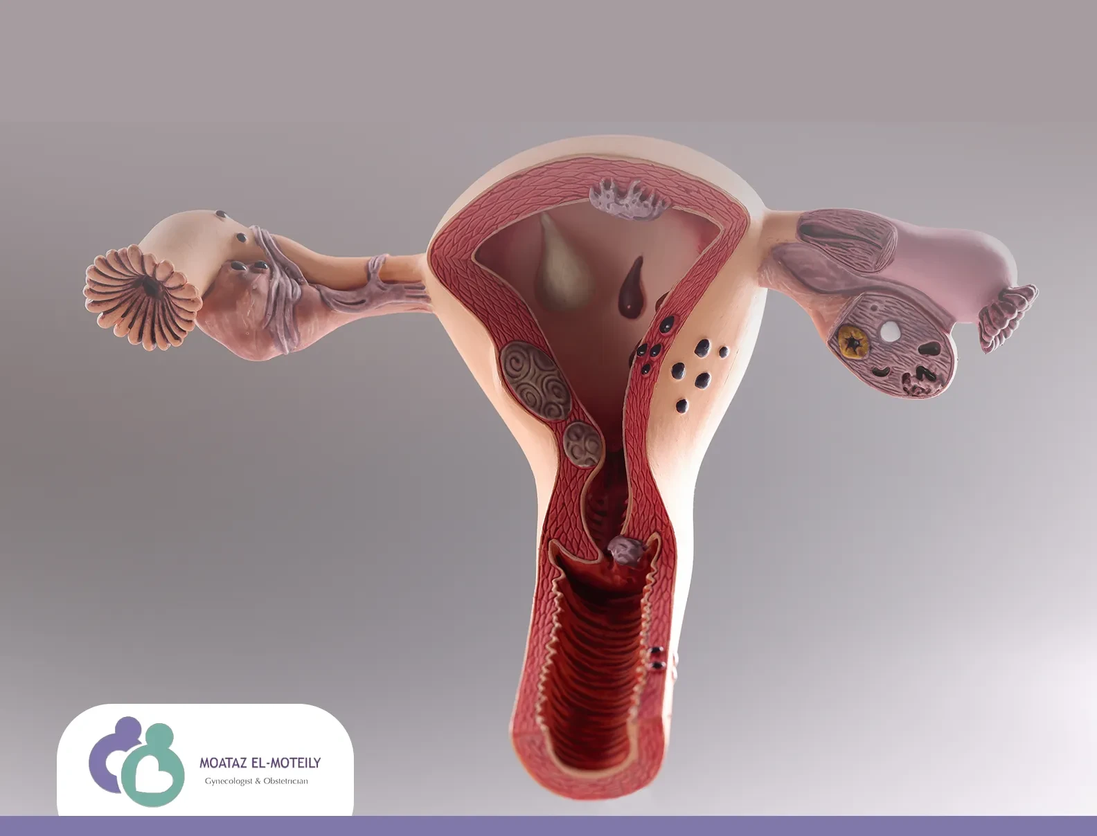 علاج الالتهابات النسائية الحادة