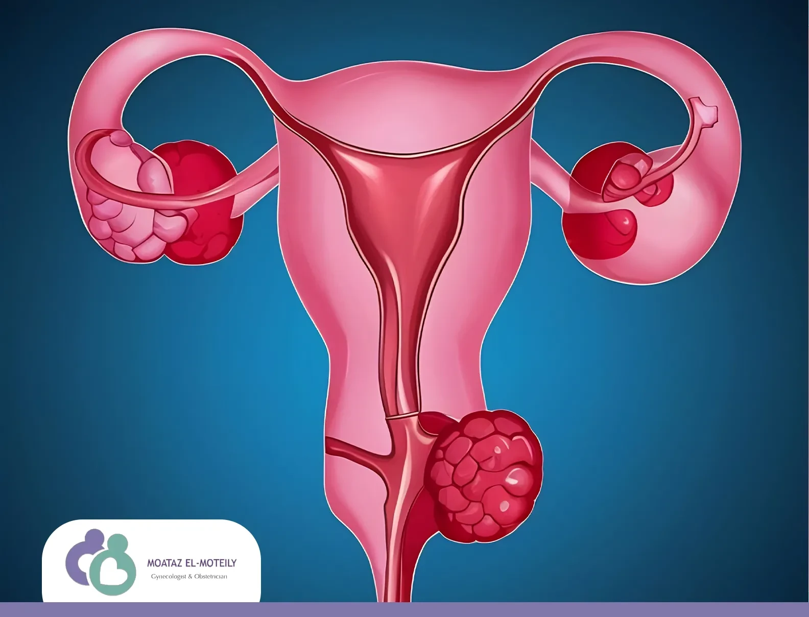 هل الورم الليفي يختفي بعد سن اليأس