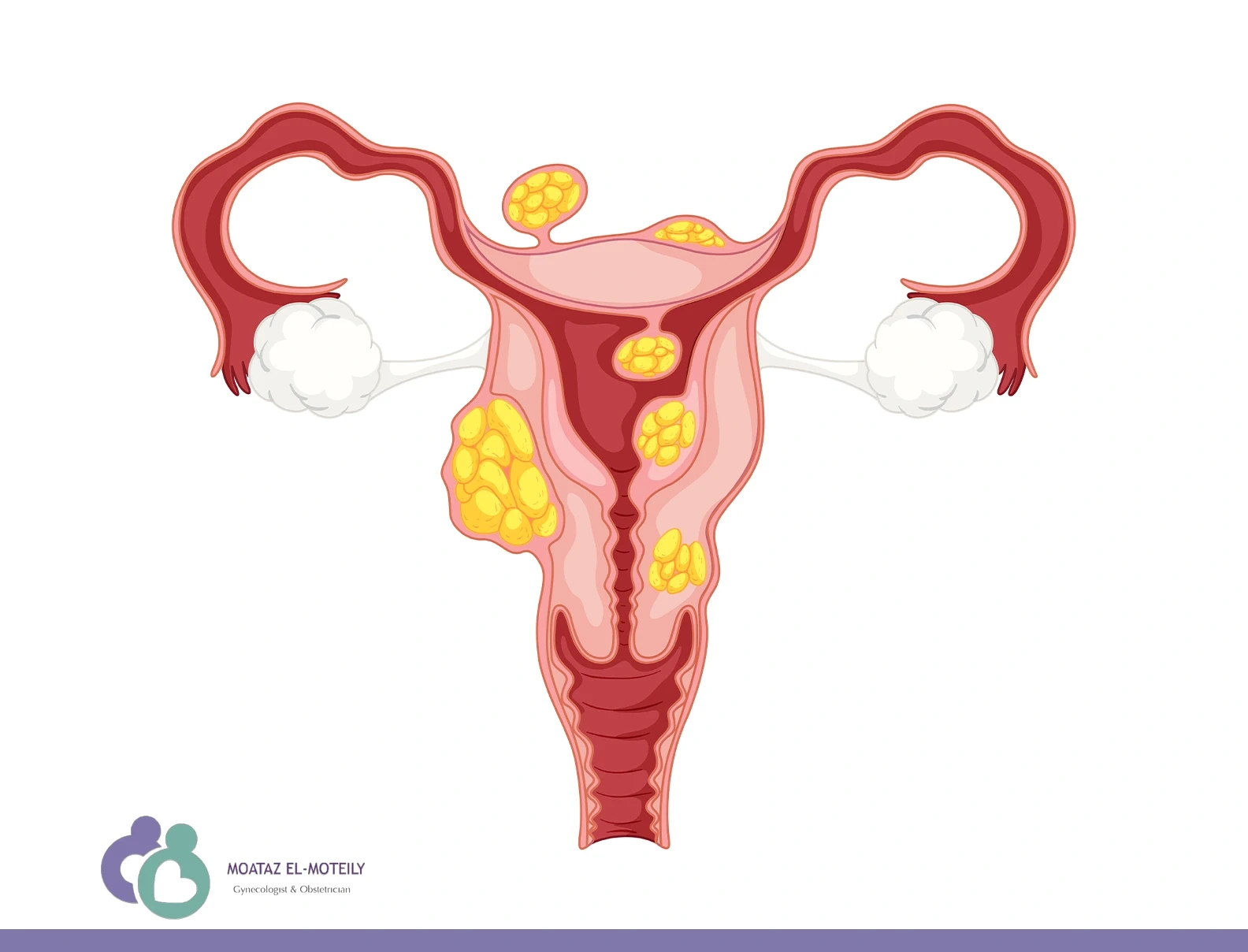 هل الورم الليفي يكبر بسرعة
