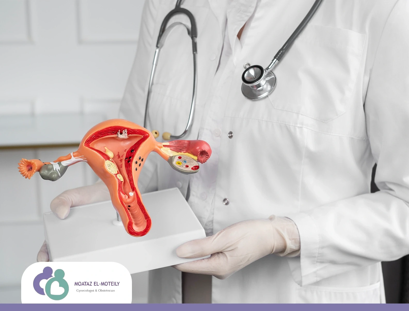 التصاق المبيض