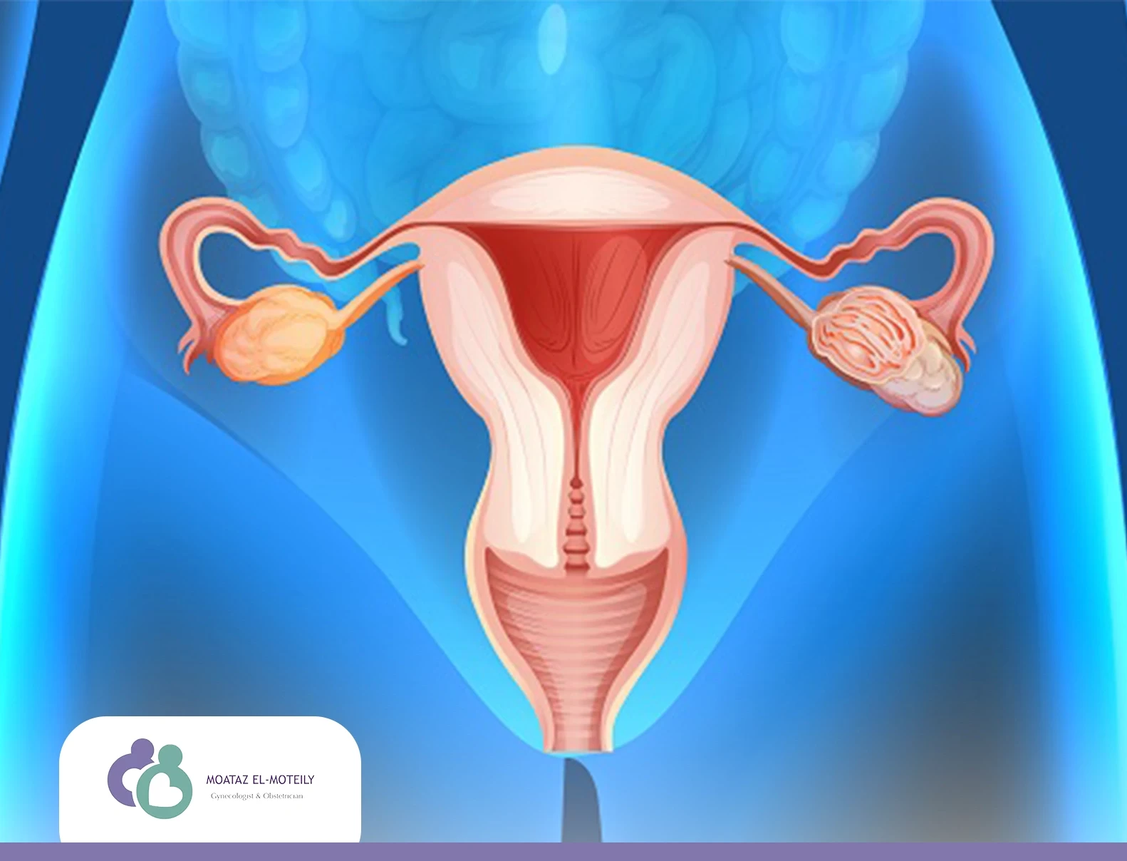 علاج التصاقات الرحم بدون جراحة