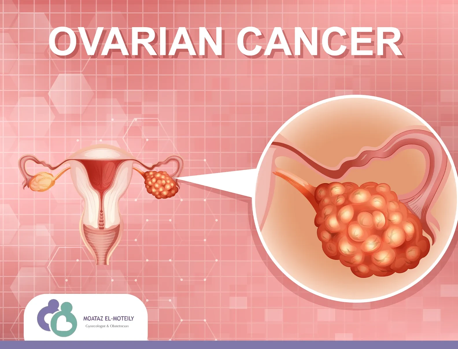 علاج ورم الرحم