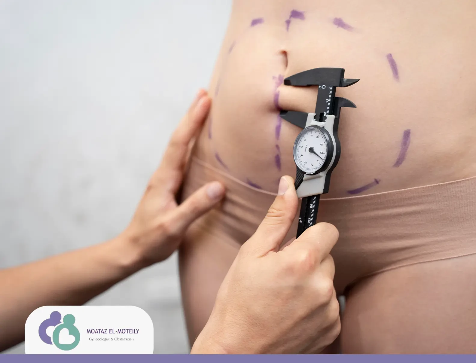 خياطة العملية القيصرية بالليزر