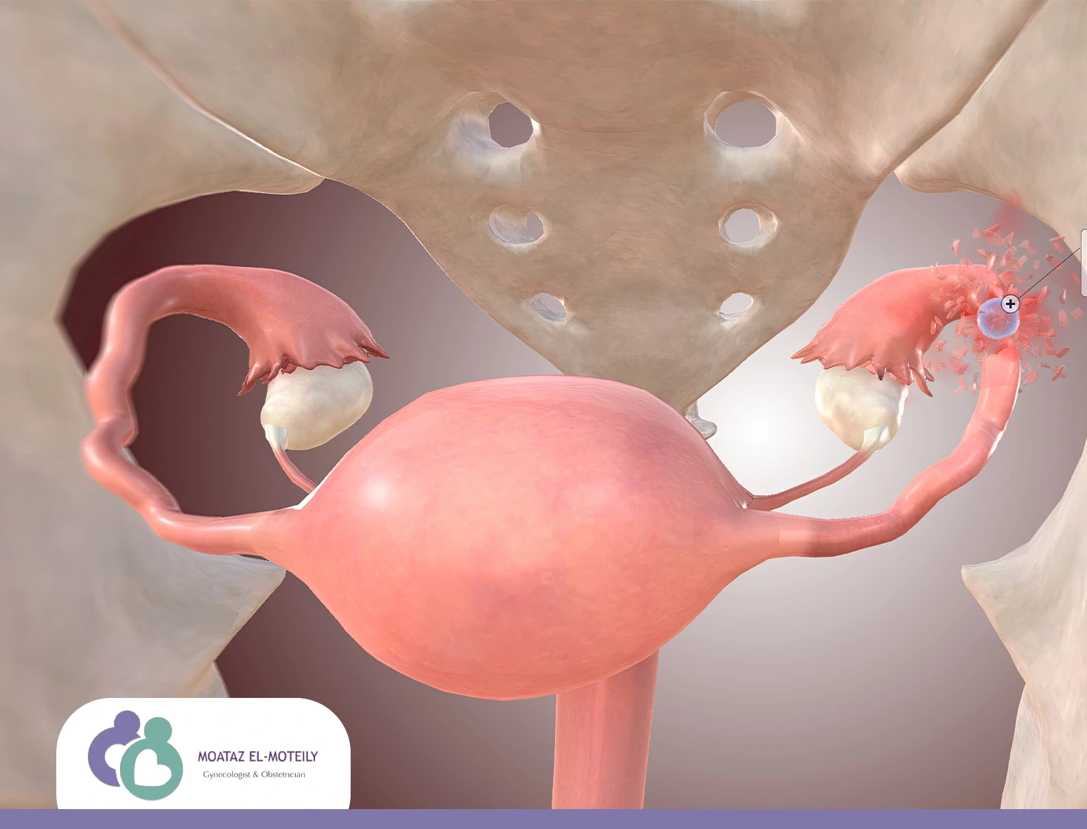 عمليات تضييق المهبل